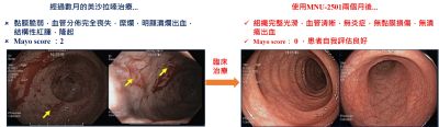 中度UC病人臨床內視鏡觀察顯示MNU-2501具備更佳的抗發炎及恢復組織結構之功能